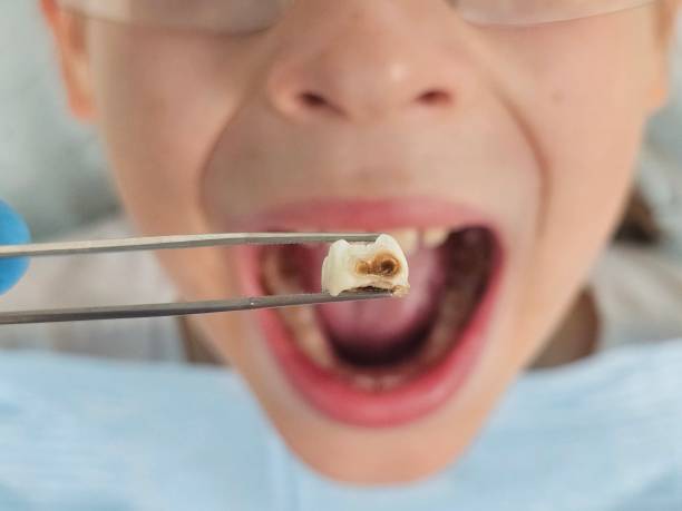Best Tooth Infection Emergency Dentist  in Bass Lake, IN